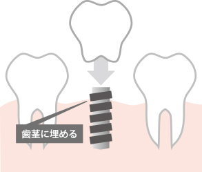 インプラント