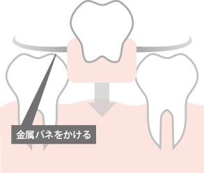 入れ歯（保険）