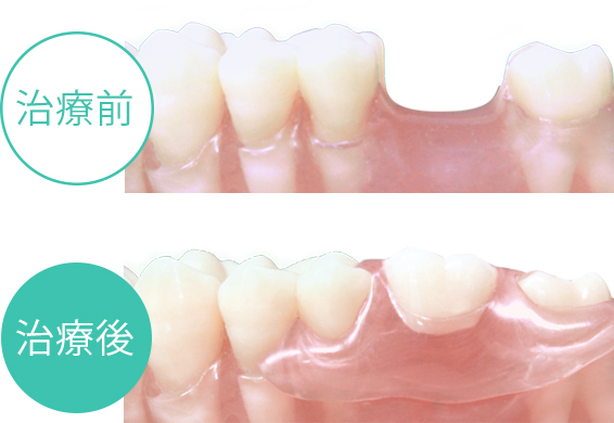 口元で目立たない/治療の痛みが少ない